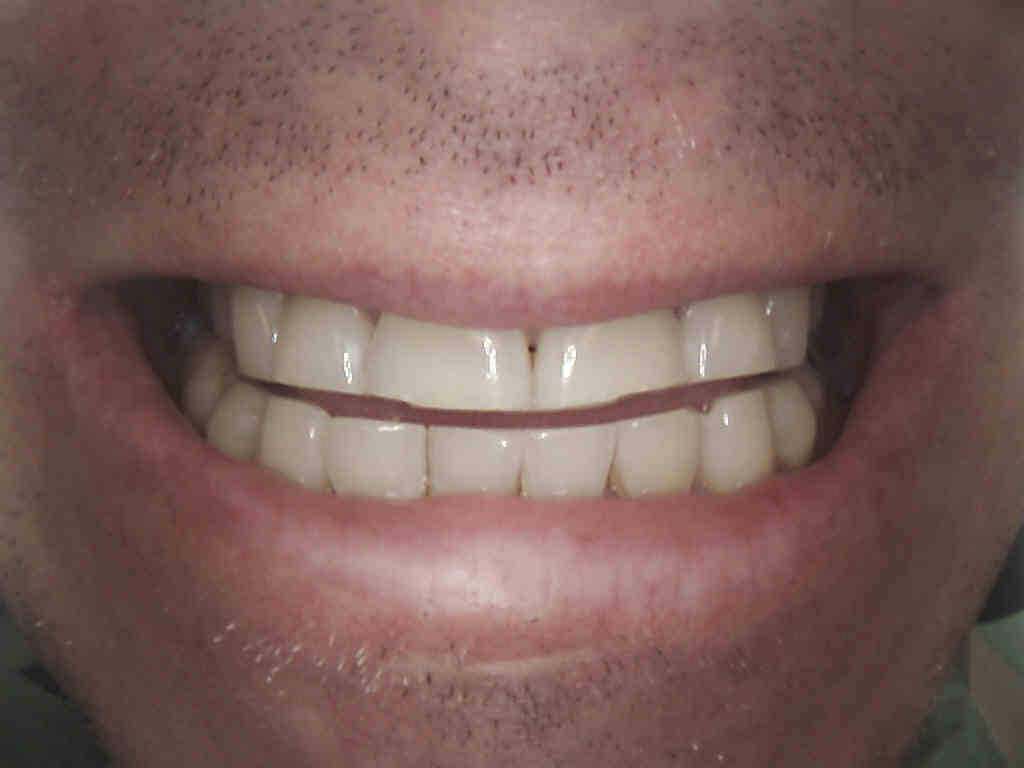 Do You Clench Or Grind Your Teeth 